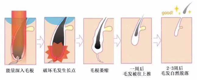 激光脱毛部位价格表2019_激光脱毛价格一览表全身_激光脱毛的一般价格表